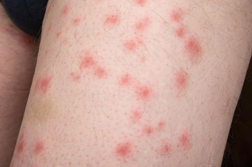 BED BUG BITES